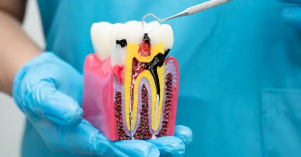 5 Post-Root Canal Tips from an Endodontist in San Francisco 5 Post-Root Canal Tips from an Endodontist in San Francisco