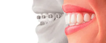 Best Alternatives to Braces | Invisalign San Francisco, CA Best Alternatives to Braces | Invisalign San Francisco, CA