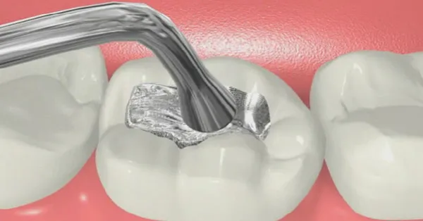 Composite vs. Amalgam Teeth Filling in San Francisco: Which is Better? Composite vs. Amalgam Teeth Filling in San Francisco: Which is Better?
