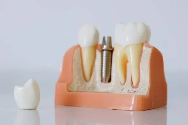 Choosing the Right Treatment for Your Damaged Tooth: Endodontic Therapy or Dental Implants? Choosing the Right Treatment for Your Damaged Tooth: Endodontic Therapy or Dental Implants