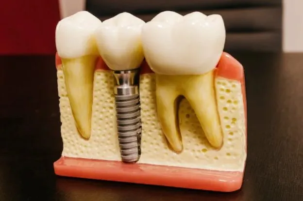 How Many Teeth Can Be Replaced by Dental Implants in San Francisco? How Many Teeth Can Be Replaced by Dental Implants in San Francisco?