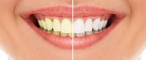 Is Teeth Whitening at The Dentist Permanent? | San Francisco Is Teeth Whitening at The Dentist Permanent? | San Francisco