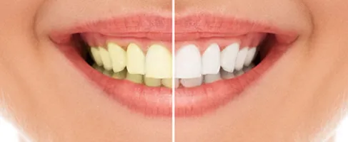 Is Teeth Whitening at The Dentist Permanent? | San Francisco Is Teeth Whitening at The Dentist Permanent? | San Francisco
