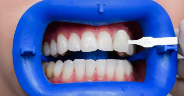 Step-by-Step Procedure of Teeth Whitening in San Francisco