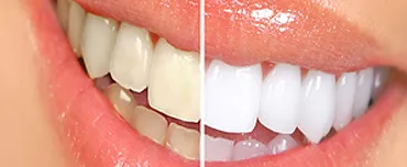 Teeth Whitening Offered By Cosmetic Dentist | San Francisco Teeth Whitening Offered By Cosmetic Dentist | San Francisco