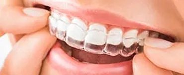 Teeth Whitening While Wearing Invisalign | San Francisco, CA Teeth Whitening While Wearing Invisalign | San Francisco, CA