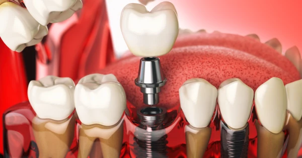Dental implants in San Francisco image showing implant-supported tooth restoration