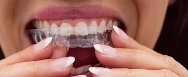 What does an Invisalign do What does an Invisalign do
