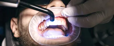 Why Professional Teeth Whitening Important? | San Francisco Why Professional Teeth Whitening Important? | San Francisco