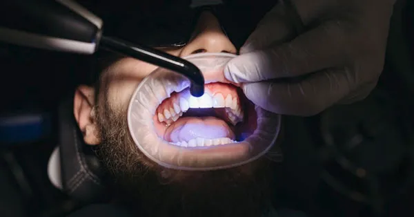Will Teeth Whitening Work With Teeth Fillings? Will Teeth Whitening Work With Teeth Fillings?