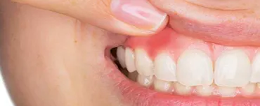 Will TMJ Affect Teeth & Gums? | TMJ Treatment San Francisco Will TMJ Affect Teeth & Gums? | TMJ Treatment San Francisco