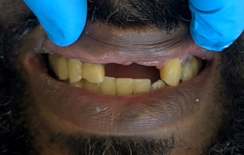 Smile before treatment, case 2