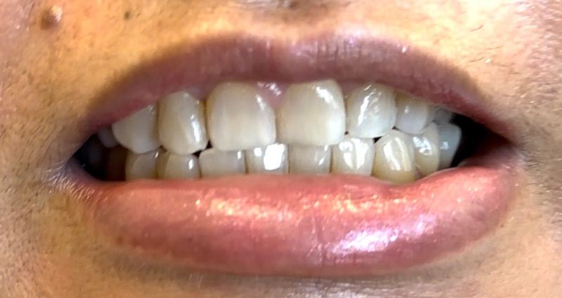 Smile before treatment, case 3