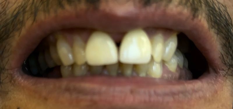 Smile before treatment, case 4