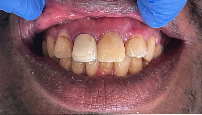 Smile before treatment, case 5