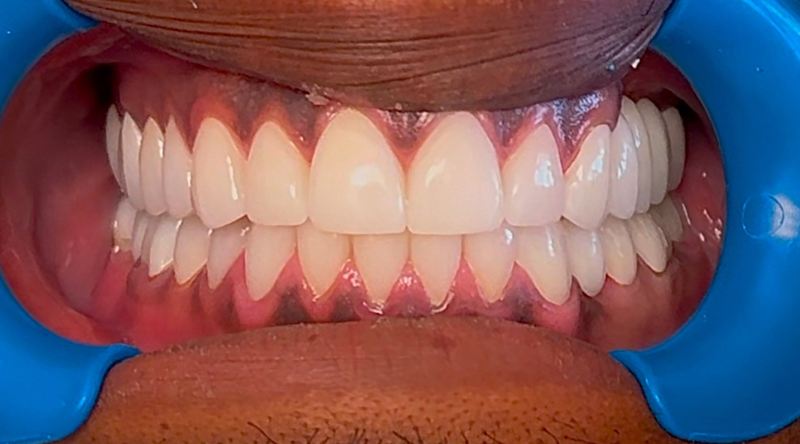Smile after treatment, case 6