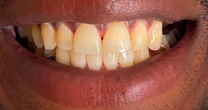 Smile before treatment, case 6