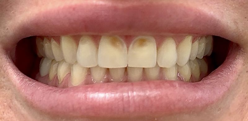 Smile before treatment, case 7