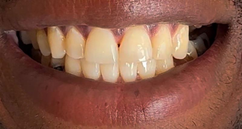 Smile before treatment, case 8