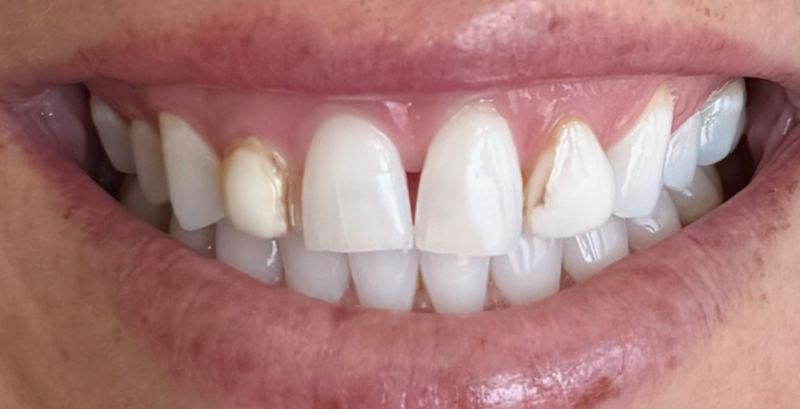 Smile before treatment, case 10