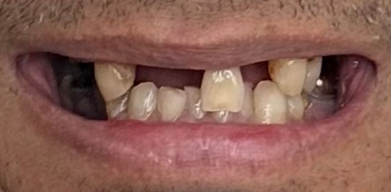Smile before treatment, case 11