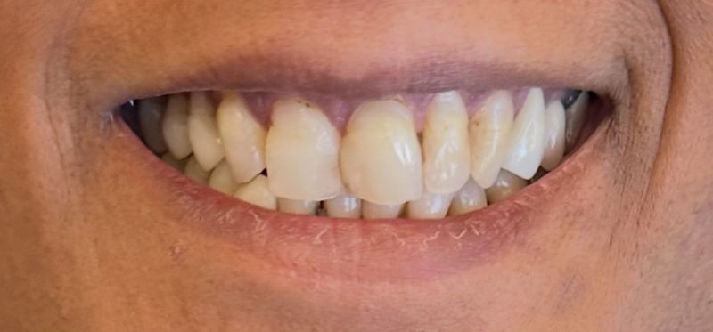 Smile before treatment, case 12