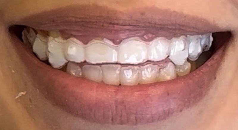 Smile before treatment, case 13