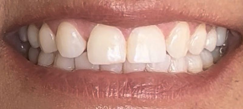 Smile before treatment, case 14