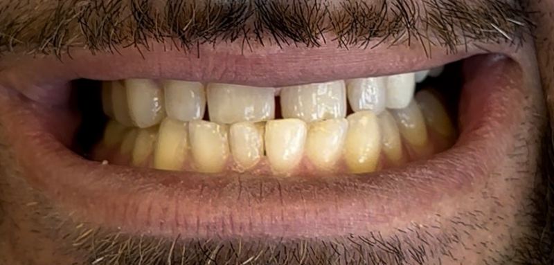 Smile before treatment, case 15