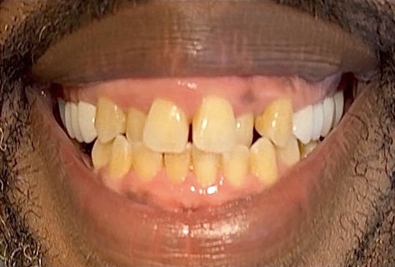 Smile before treatment, case 17