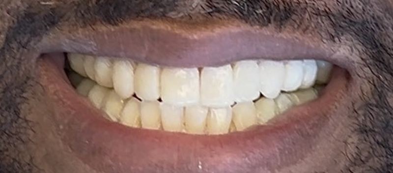 Smile after treatment, case 19