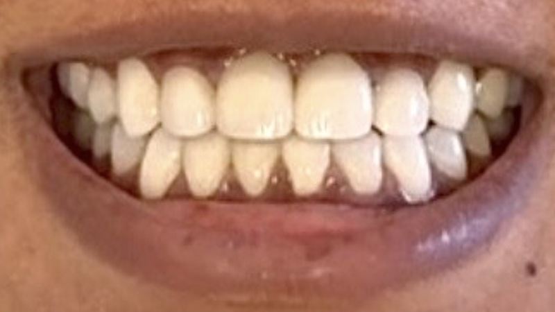 Smile after treatment, case 20