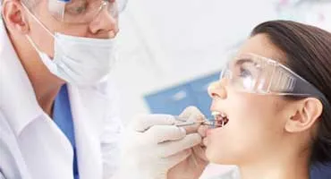 Dental Sealant San Francisco Dental Sealant San Francisco