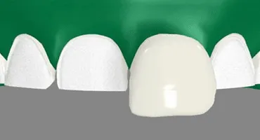 Veneers & Laminates San Francisco Veneers & Laminates San Francisco