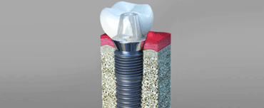 Dental Implants San Francisco