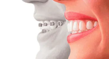 Invisalign in San Francisco Invisalign in San Francisco
