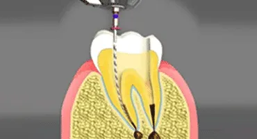 Endodontist in San Francisco Endodontist in San Francisco
