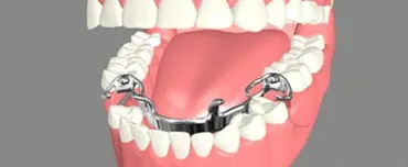 Removable Dentures Removable Dentures