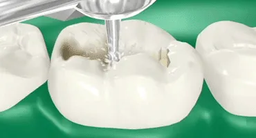 Teeth Filling San Francisco | Soma Dental Teeth Filling San Francisco | Soma Dental