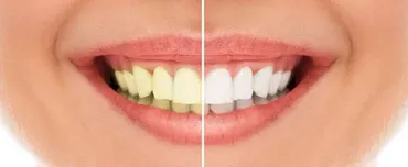Teeth Whitening in San Francisco Teeth Whitening in San Francisco